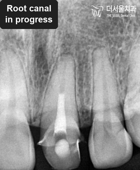 Close-up dental X-ray of an upper front tooth during root canal treatment