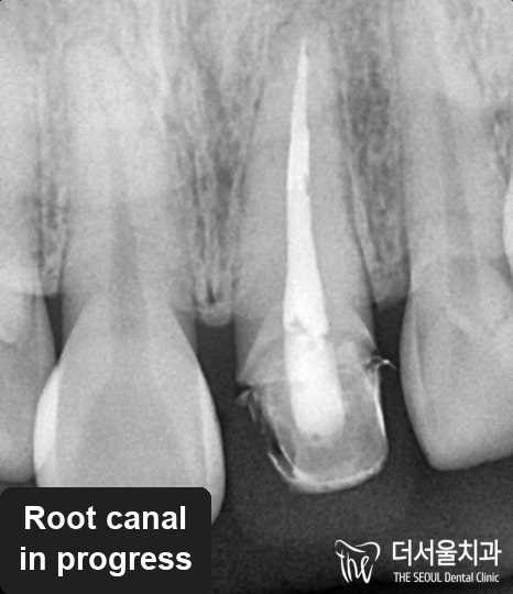 Close-up dental X-ray of the same front tooth showing the post cemented inside the root