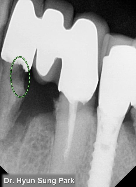 Close-up dental X-ray of a front tooth with the root outlined by a dashed circle