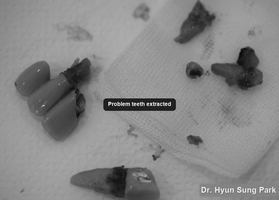 Extracted tooth roots and fragments laid out after removal