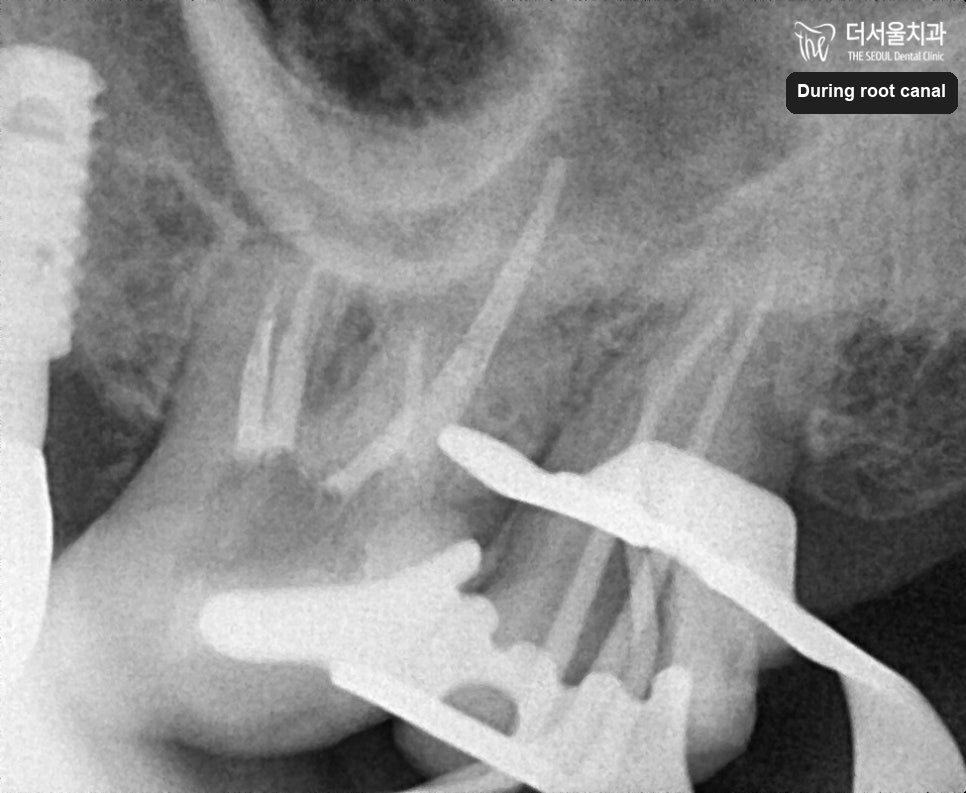 Close-up dental X-ray showing the canals being worked during root canal treatment