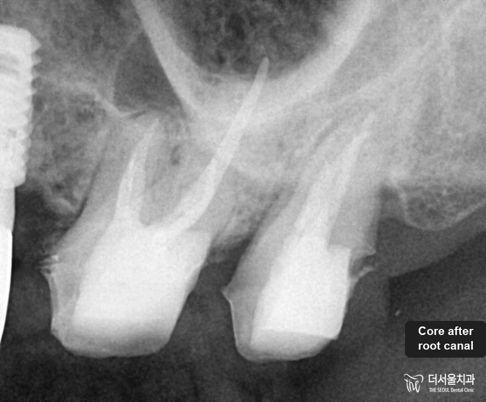 Close-up dental X-ray after the root canal, with the core built up ready for a crown