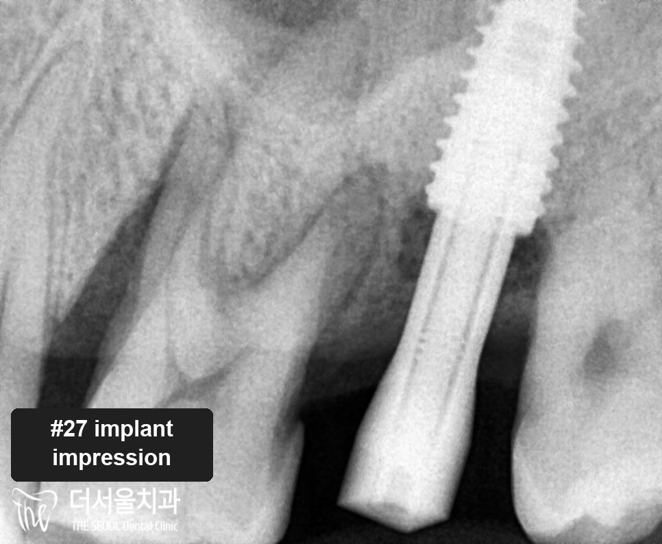Close-up dental X-ray showing an implant fixture fractured in the upper jaw