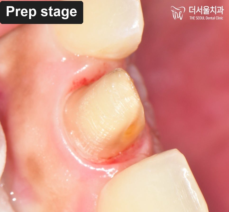Intraoral close-up of the front tooth shaped and ready for the crown to be fitted