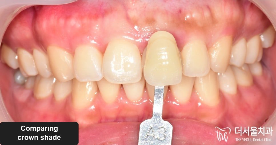 A Front Tooth Turning Dark: What the Colour Is Telling You