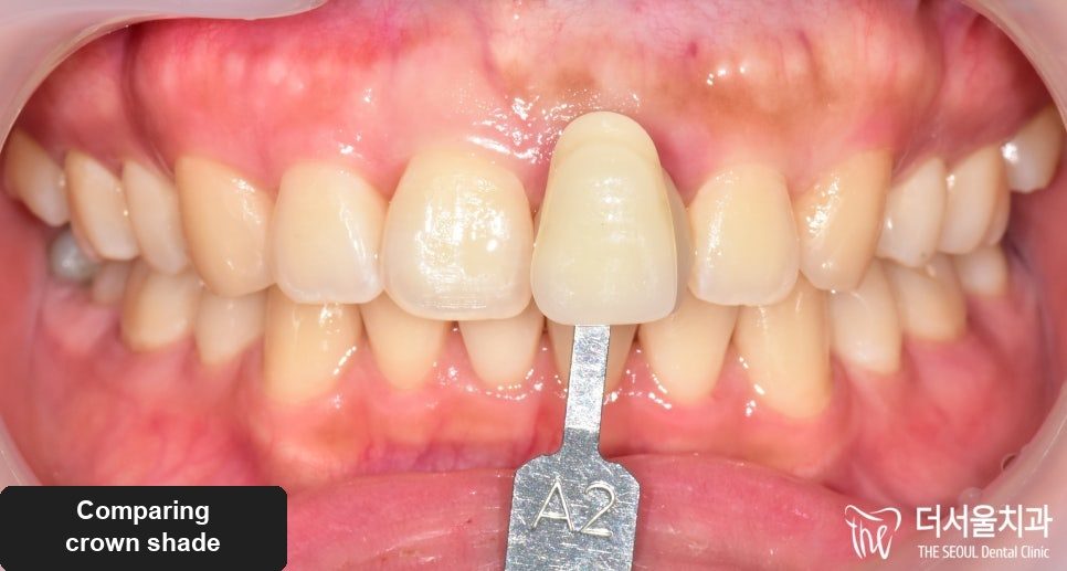 Front teeth with a dental shade tab marked A2 held against them, the closer colour match