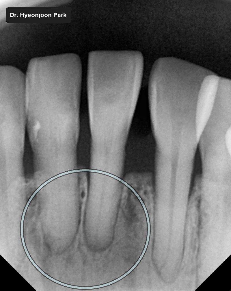 Close-up dental X-ray of the lower front teeth with the bone level between two roots circled