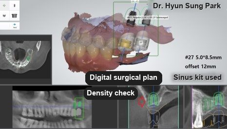 Implant planning software showing a three-dimensional scan of the jaws alongside cross-sectional X-ray slices, with the planned implant drawn into the bone