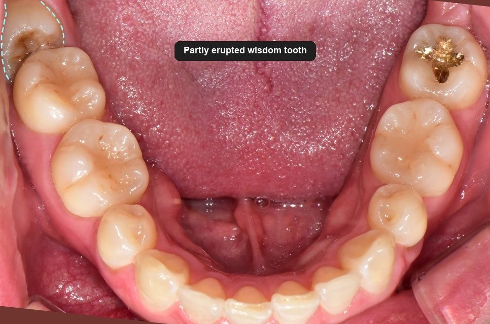 Intraoral photograph of the lower teeth from above with the wisdom tooth visible at the back, angled forwards