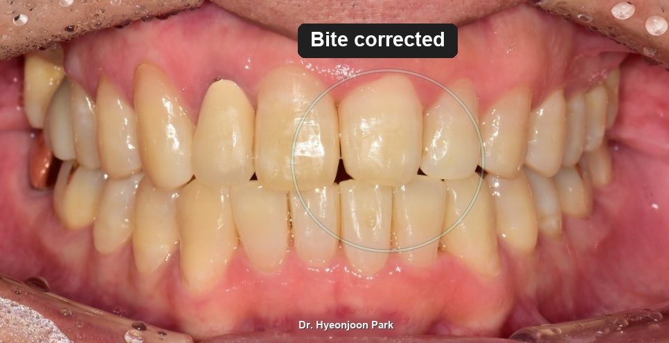 Intraoral photograph of the front teeth in bite, now with the upper teeth closing in front of the lower