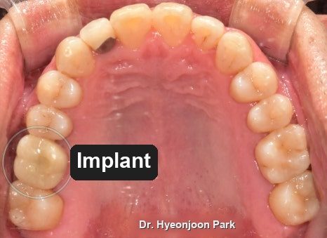 Occlusal photograph of the upper arch with the implant crown circled in the completed arch