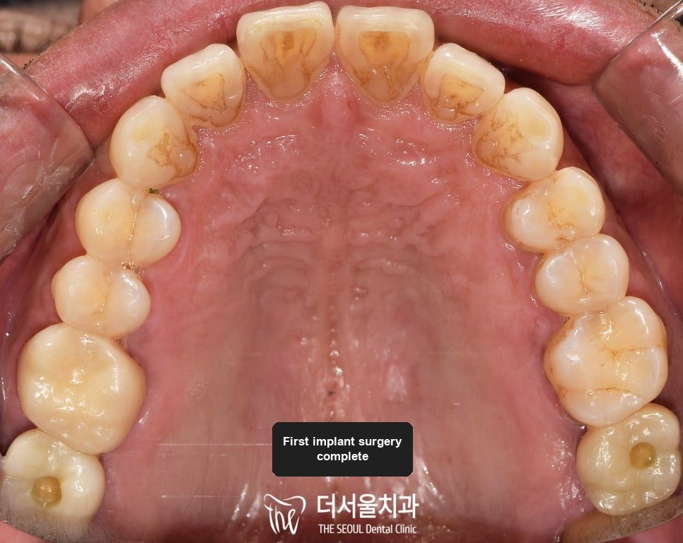 Intraoral photograph of the upper teeth from below after the first implant surgery