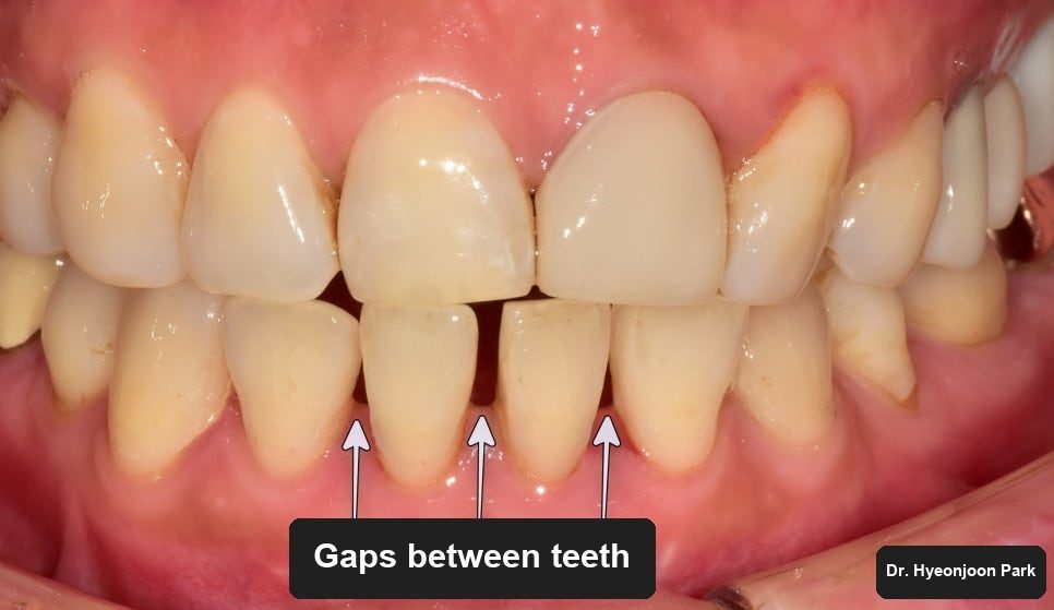 Black Triangles and a Failing Resin Repair on Lower Front Teeth