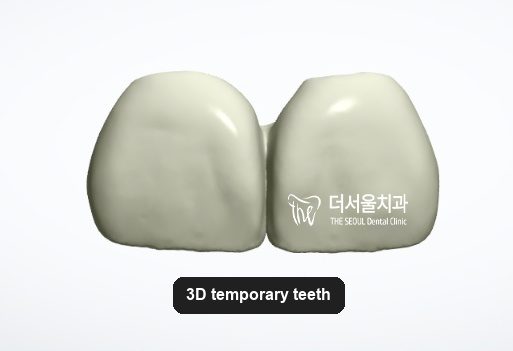 Rendered image of the temporary front teeth designed on the computer before they are milled