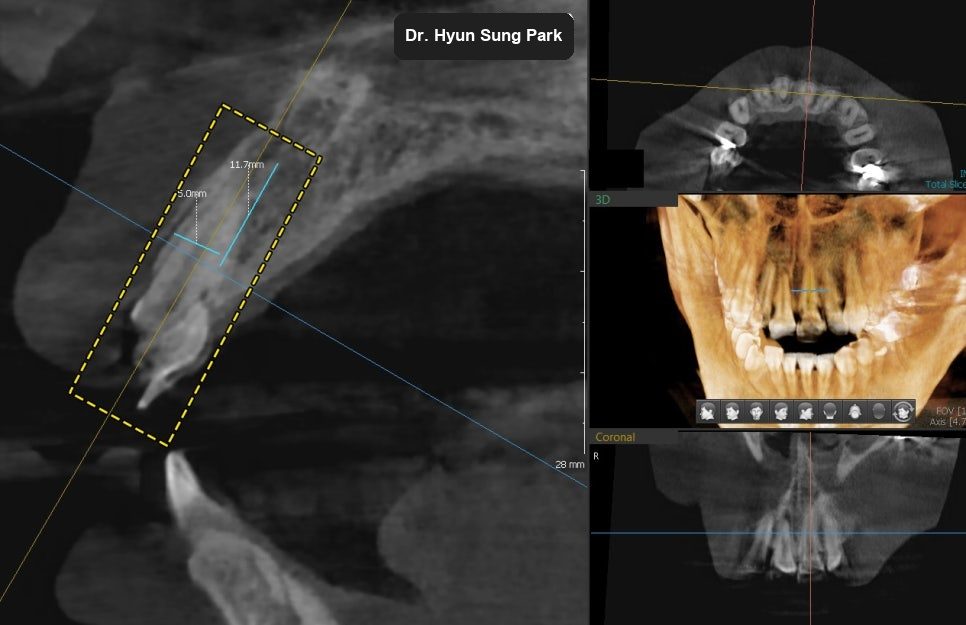 CT cross-sections of the upper front jaw with the bone available for an implant outlined in green