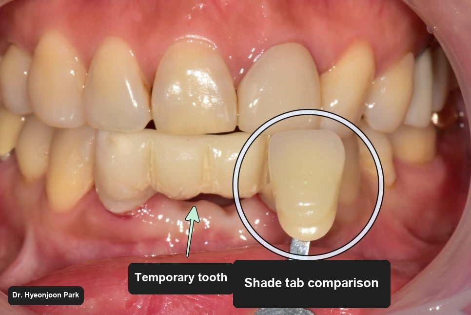 Intraoral photograph of the front teeth with a temporary tooth in place, circled for comparison against the neighbouring teeth