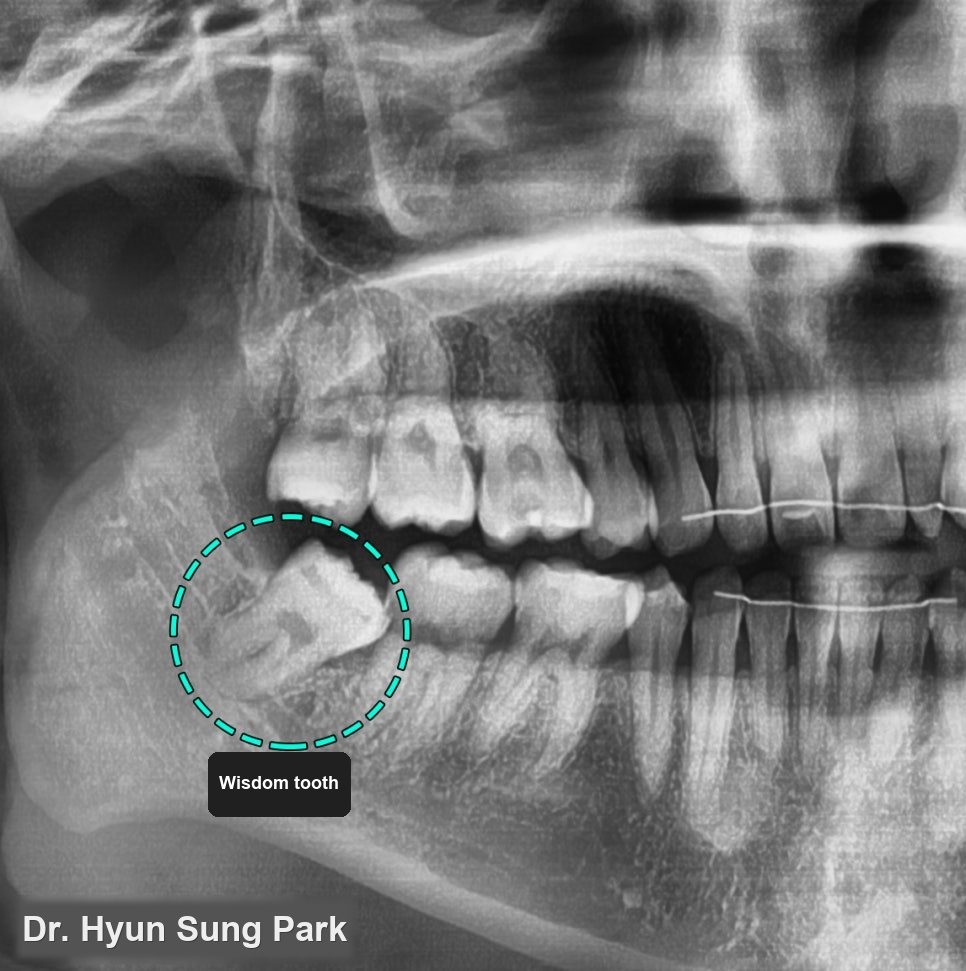 Wisdom Tooth Removal in Korea: The Scan, the Surgery and the Week After