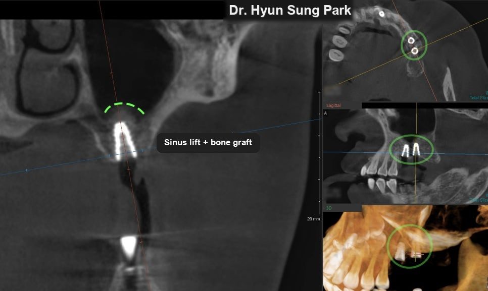 CT cross-section of the upper jaw with an implant in place and the raised floor of the sinus outlined in green above it