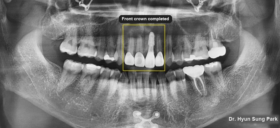 A Front Tooth Broken in a Fall: Implant and Making the Crown Last