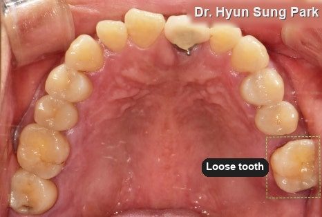 Molar Implant Procedure in Korea: Step by Step, and Aftercare