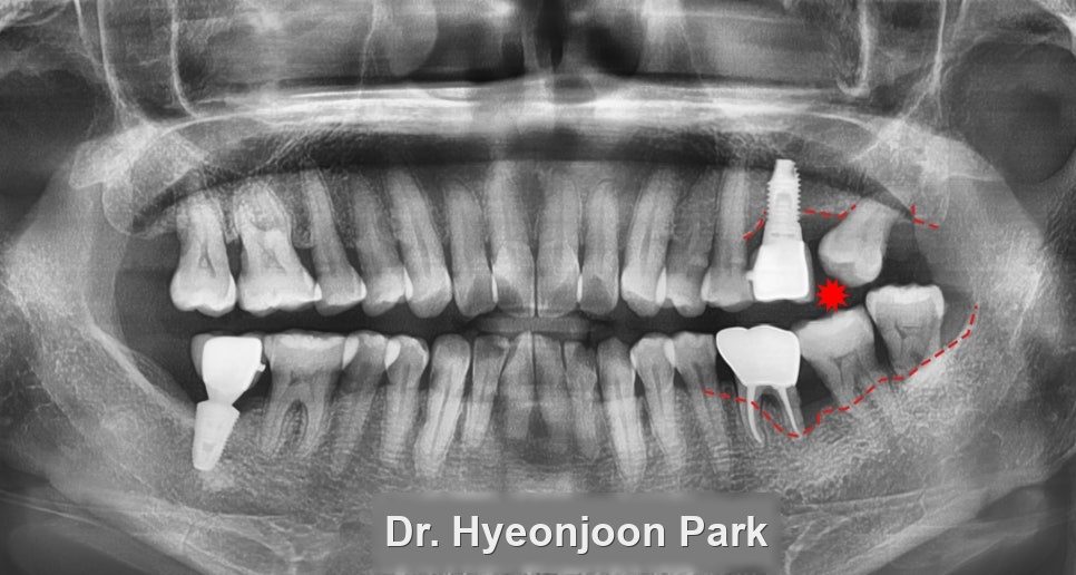 Implants with Sinus Lift and Sedation: Costs and Timeline