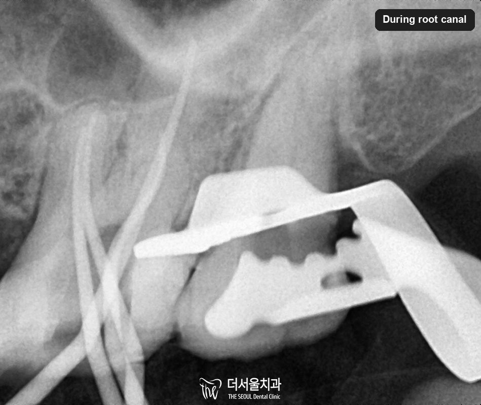 Close-up dental X-ray taken during root canal treatment with an instrument in the canal