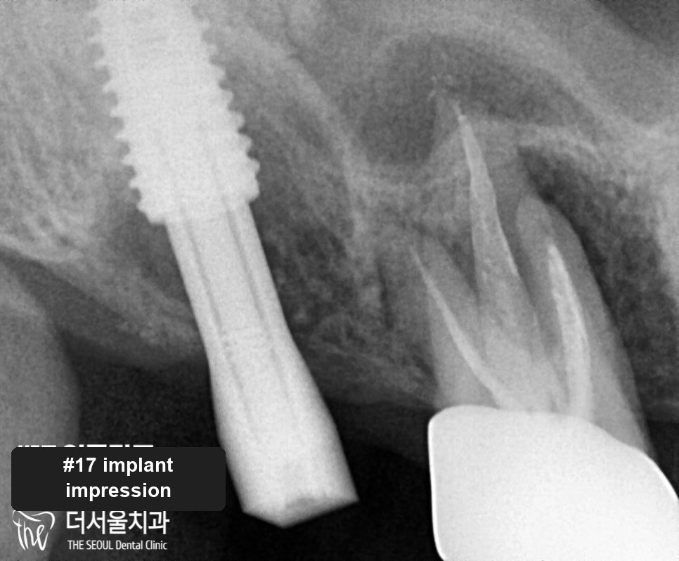 Close-up dental X-ray showing a second fractured implant fixture on the other side