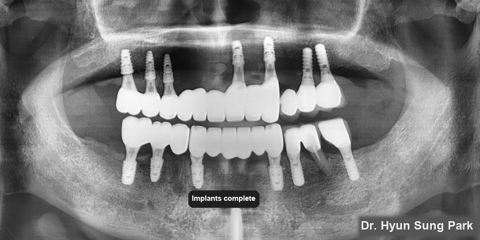 Panoramic dental X-ray showing the front implants restored