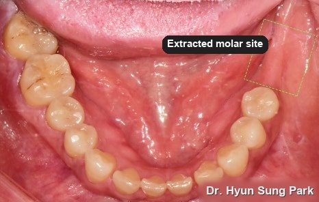 Intraoral photograph of the lower teeth seen from above, with a back tooth area outlined