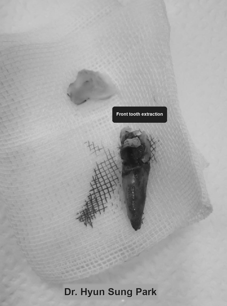 The extracted root of a front tooth laid on gauze after removal