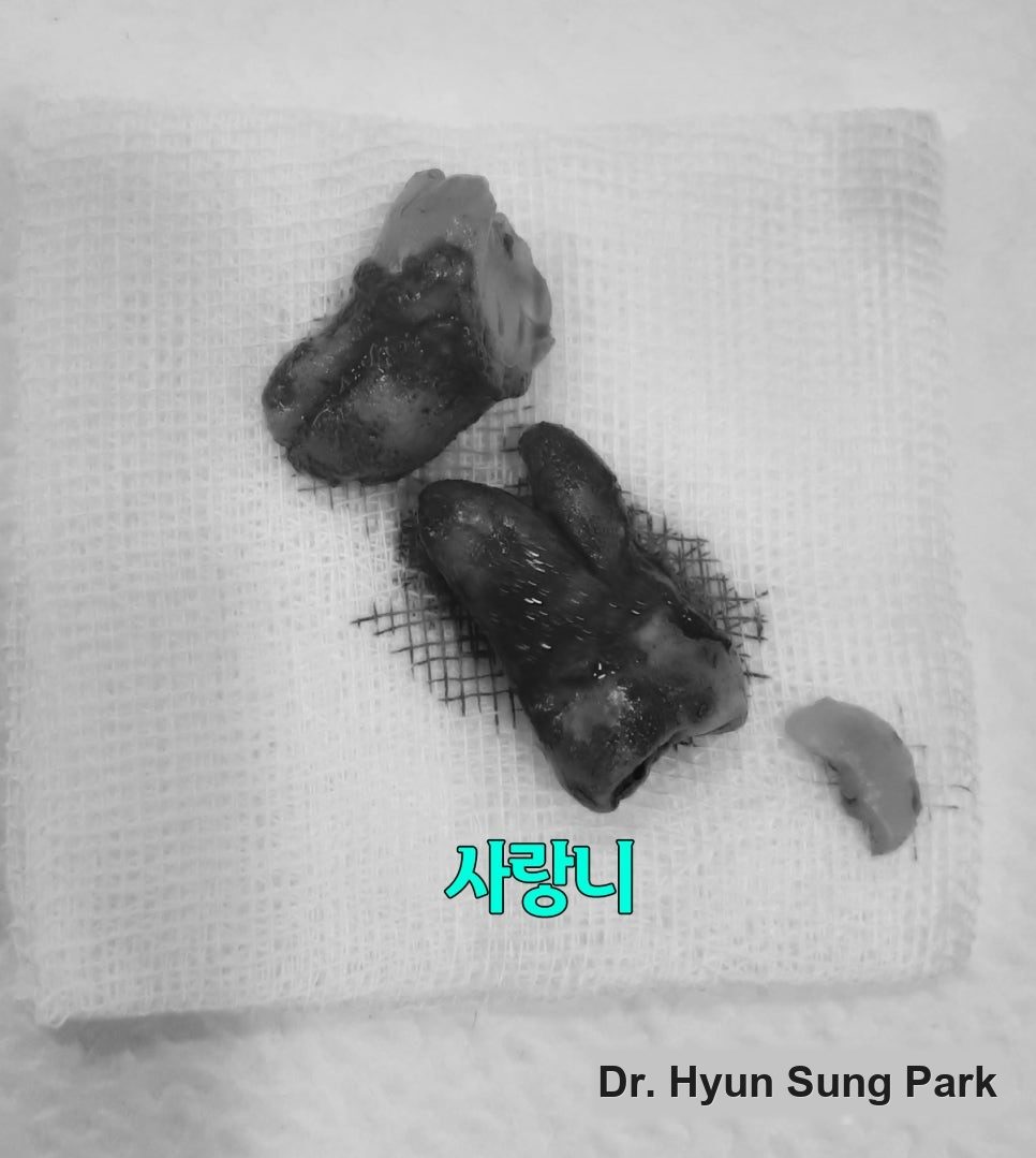 An extracted wisdom tooth, sectioned during removal, laid on gauze