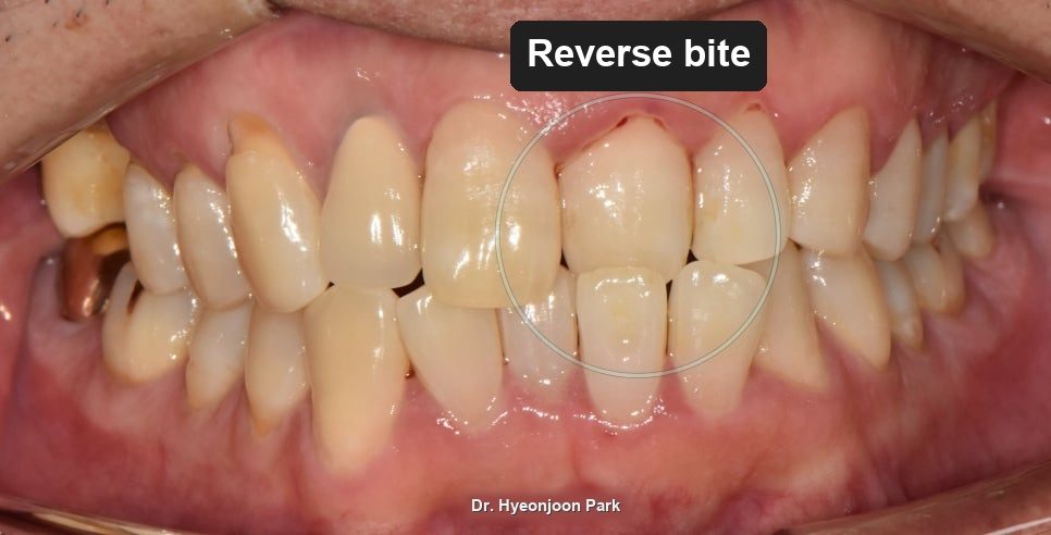 Braces and an Implant Both Needed: Which Comes First?