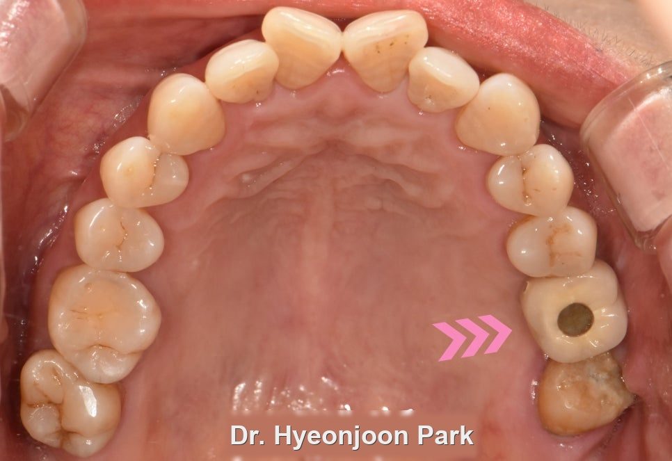 Intraoral photograph of the upper teeth seen from below, with arrows pointing to a darkened back tooth