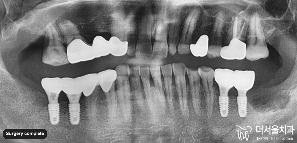 Panoramic dental X-ray taken after surgery showing the implants placed across both jaws