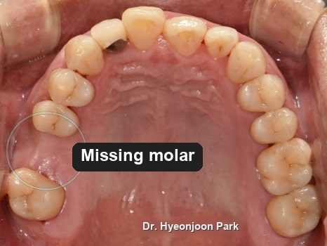 Occlusal photograph of the upper arch with a circle marking the space where a molar is missing