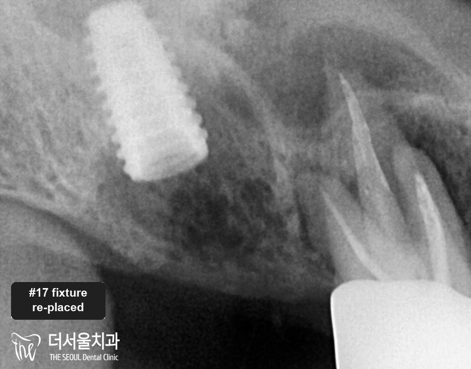 Close-up dental X-ray showing a replacement fixture seated in the jaw