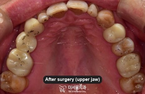 Intraoral photograph of the upper teeth from below after treatment