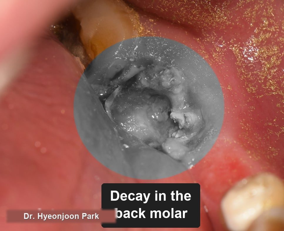Close-up photograph of a back tooth with advanced decay, found once the bridge was removed
