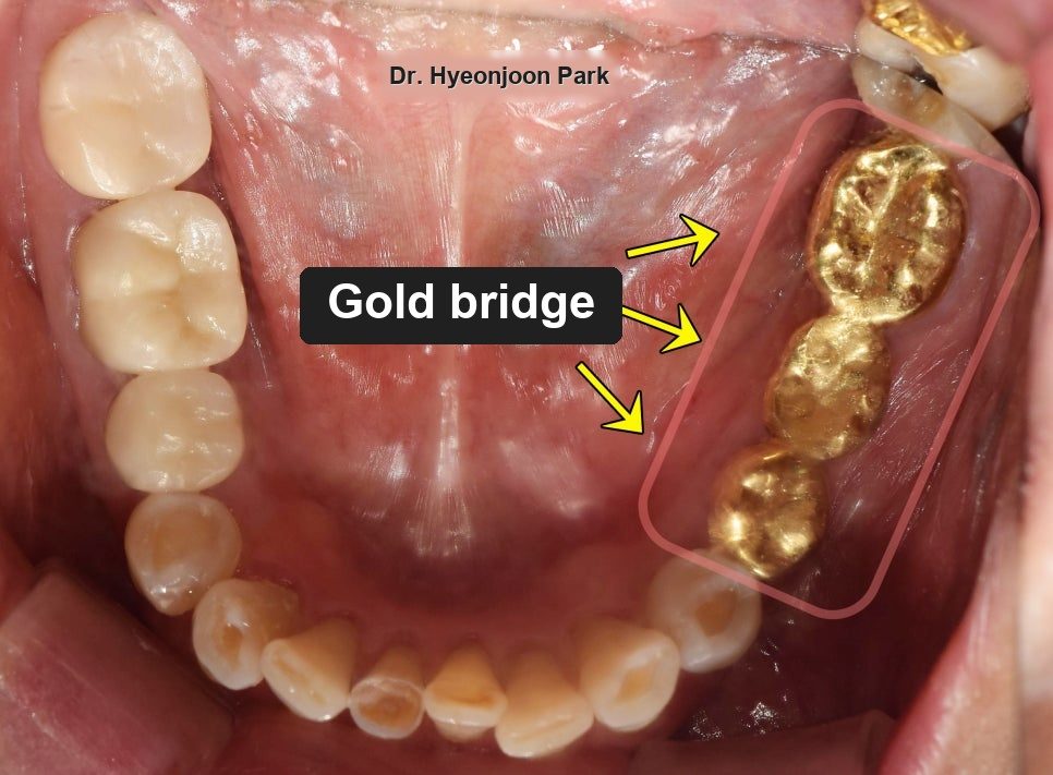 Intraoral photograph of the lower teeth with arrows pointing to an old gold bridge at the back