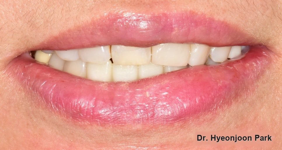 Close-up photograph of the mouth at lip level with the finished front teeth visible