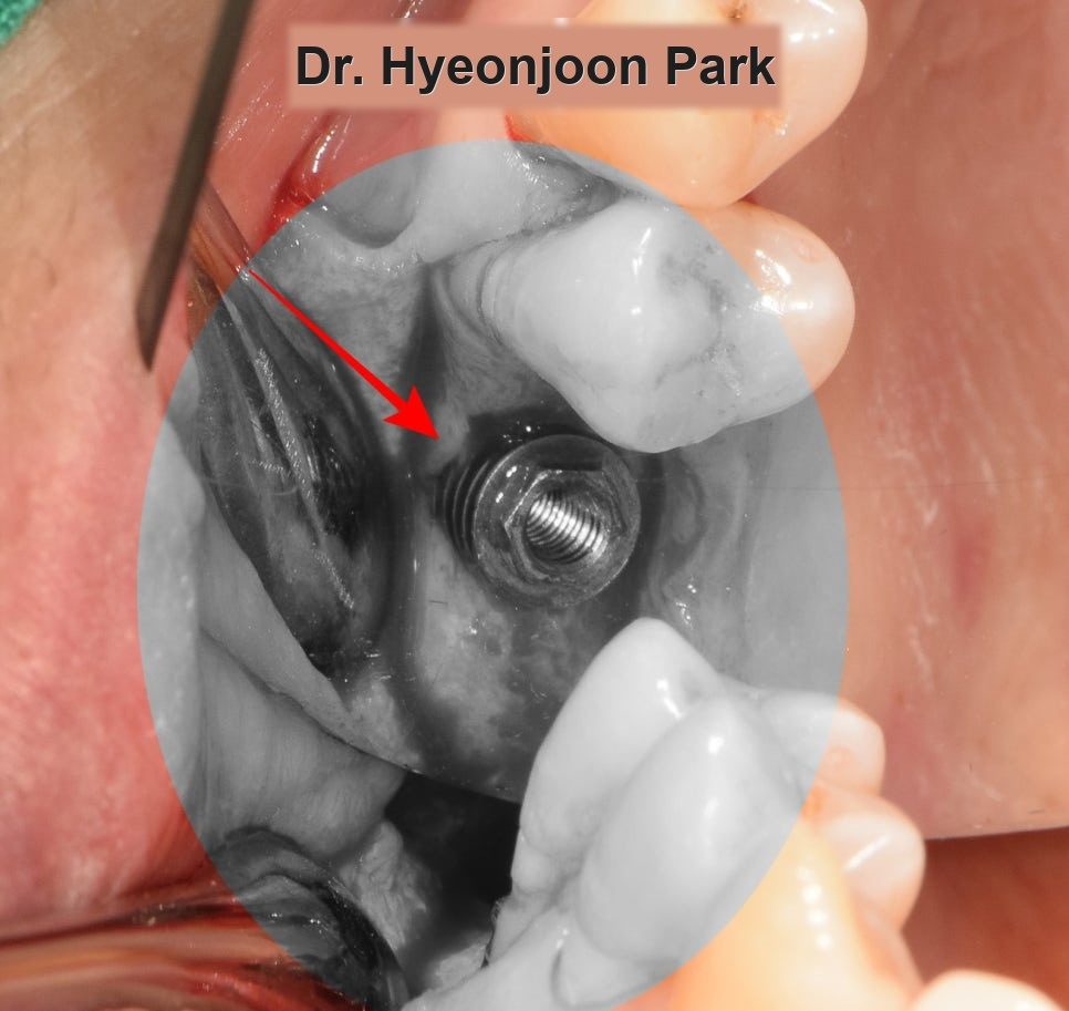 Close-up photograph taken during surgery showing the top of an implant fixture seated in the jaw, indicated by an arrow