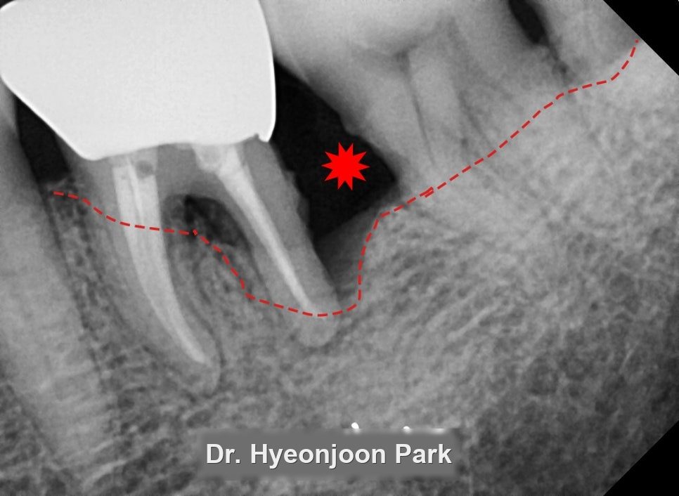 Close-up dental X-ray of an upper back tooth with a red asterisk in the space above it and the outline of the sinus drawn as a dashed red line