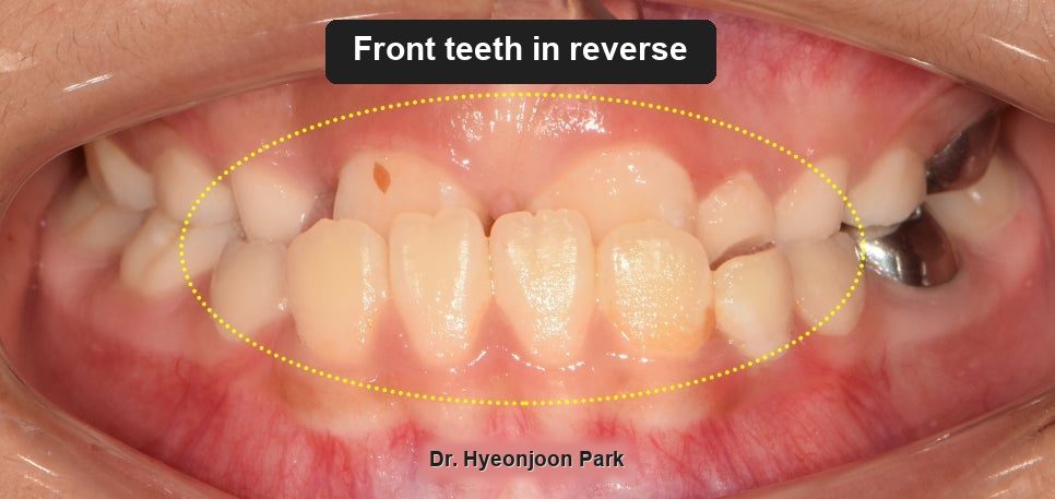 A Child’s Underbite: Why the Timing Decides the Options