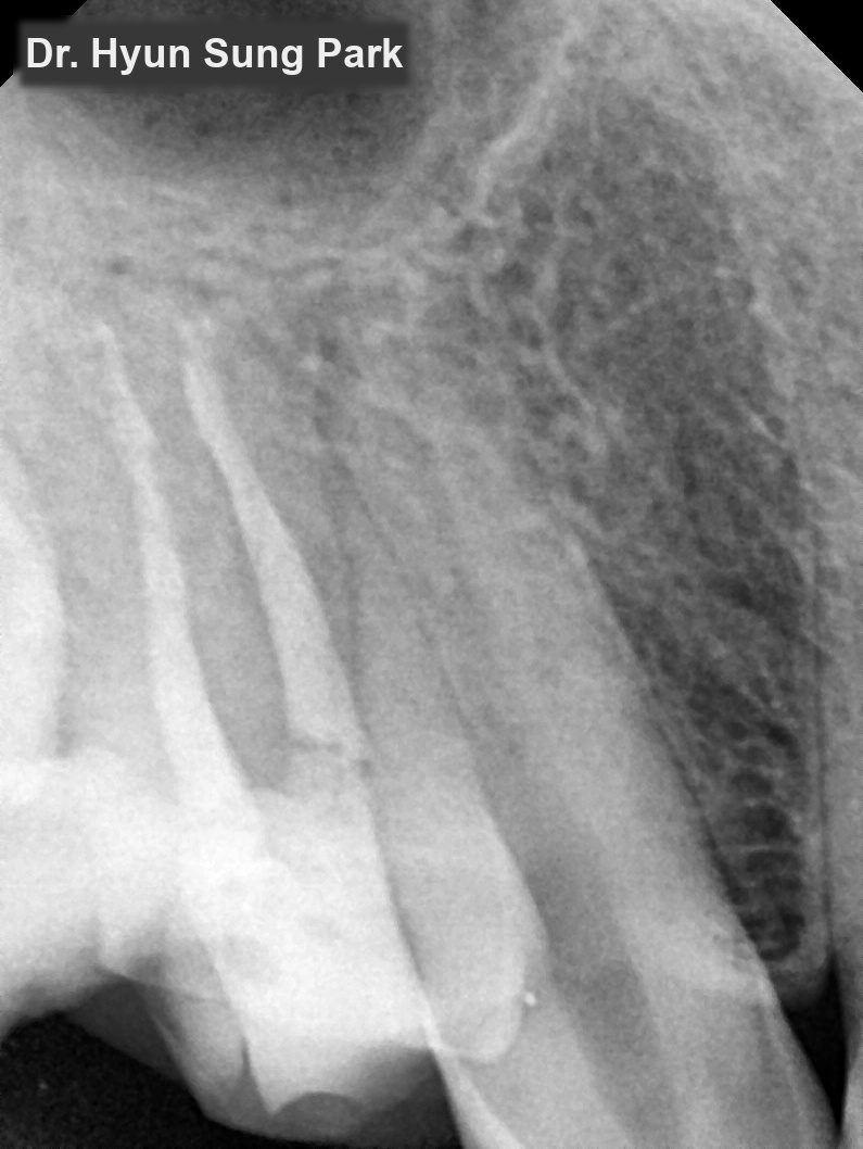 Close-up dental X-ray of the upper back teeth after treatment