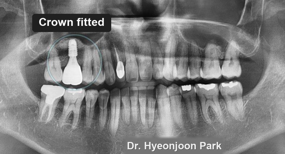Panoramic dental X-ray showing the finished crown fitted onto the implant