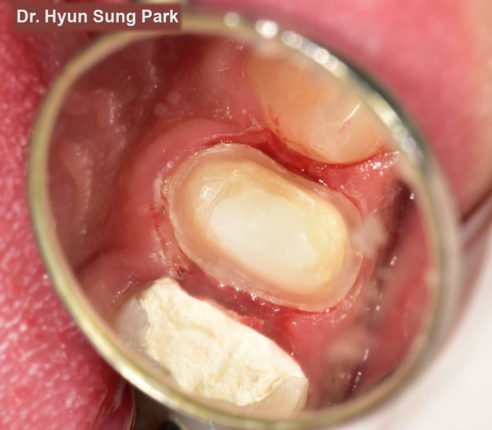 Close-up mirror view of a tooth opened for root canal treatment, with a temporary filling and a cotton pellet inside it