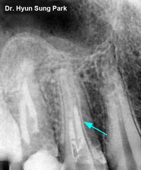 Close-up dental X-ray with an arrow pointing to the root of a back tooth