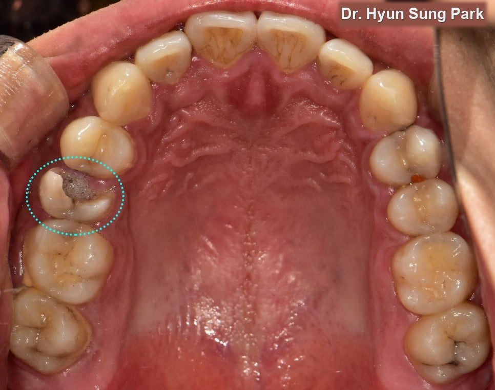 Stopping Root Canal Treatment Halfway: What Happens Next