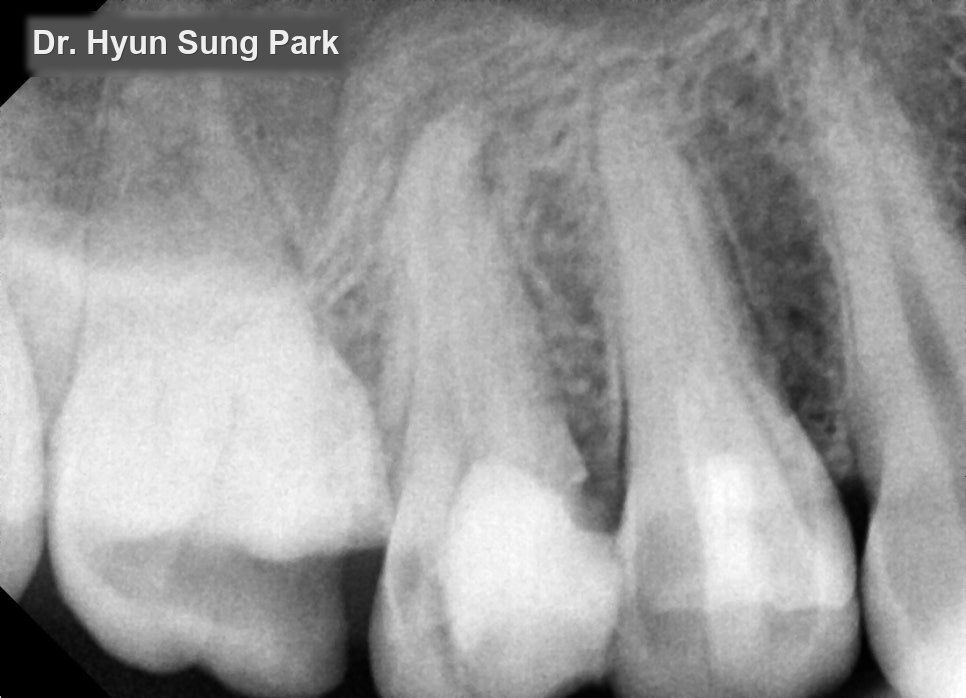 Close-up dental X-ray showing the roots of the upper back teeth and the bone around them