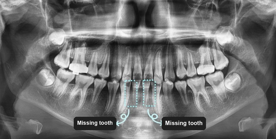 Panoramic dental X-ray with two arrows marking sites where a tooth has not developed
